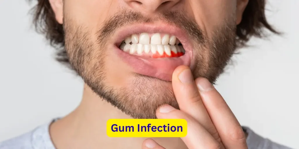Gum Infection